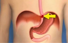 Yemek Borusu Ameliyatı Riskleri ve Sonrası Yemek Borusu Ameliyatı Riskleri ve Sonrası