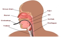 Yemek Borusu Reflüsü Belirtileri Nelerdir? Yemek Borusu Reflüsü Belirtileri Nelerdir?