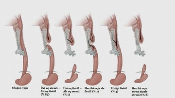 Bebeklerde Yemek Borusu Darlığı Belirtileri ve Tedavisi Bebeklerde Yemek Borusu Darlığı Belirtileri ve Tedavisi