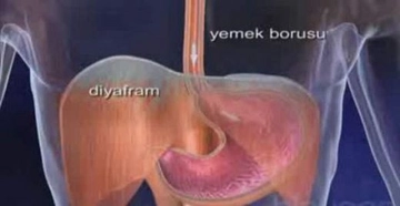 Mide Yemek Borusu Ağrısı Belirtileri ve Tedavisi Mide Yemek Borusu Ağrısı Belirtileri ve Tedavisi