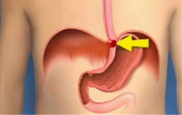 Yemek Borusu Tıkanıklığı Belirtileri ve Tedavisi Yemek Borusu Tıkanıklığı Belirtileri ve Tedavisi